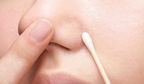 长闭合性粉刺怎么治疗 教你5招去除粉刺恢复光滑肌肤
